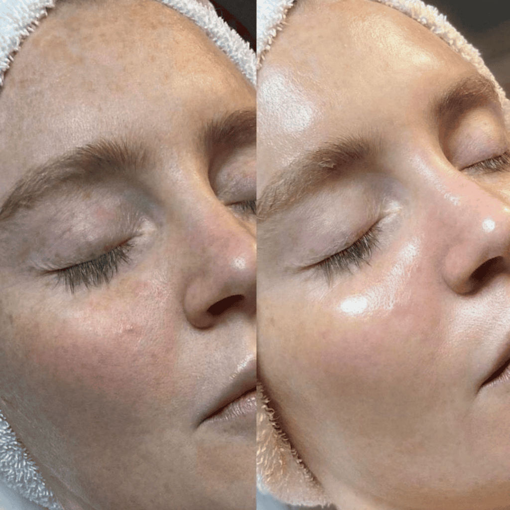 Medikal Hydrafacial Cilt Bakımı
