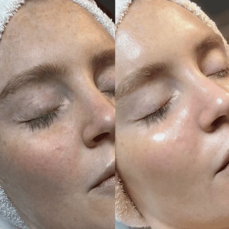 Medikal Hydrafacial Cilt Bakımı Öncesi ve Sonrası